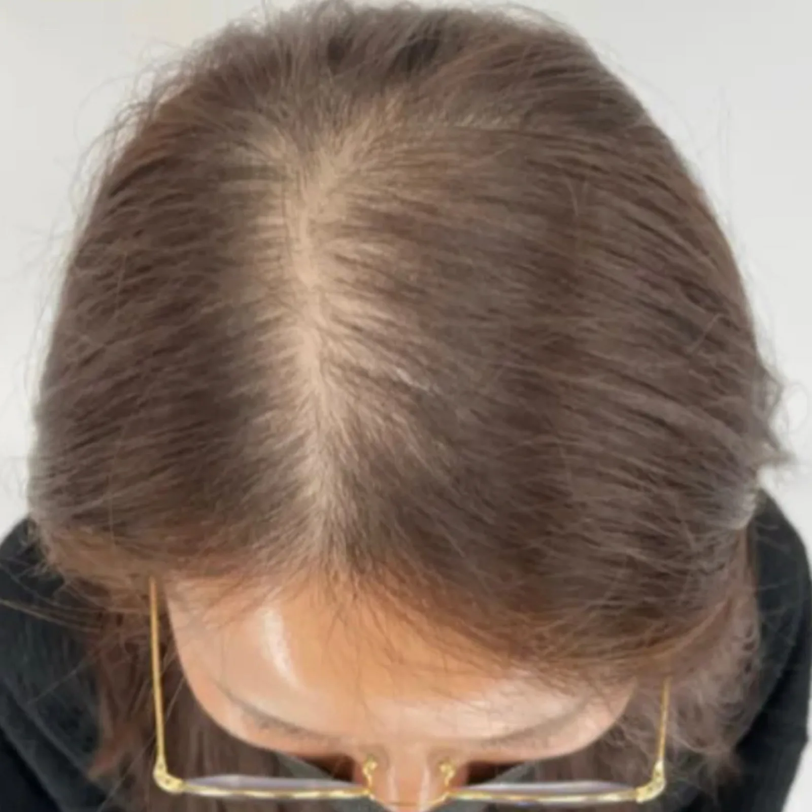 Perma Scalp Before