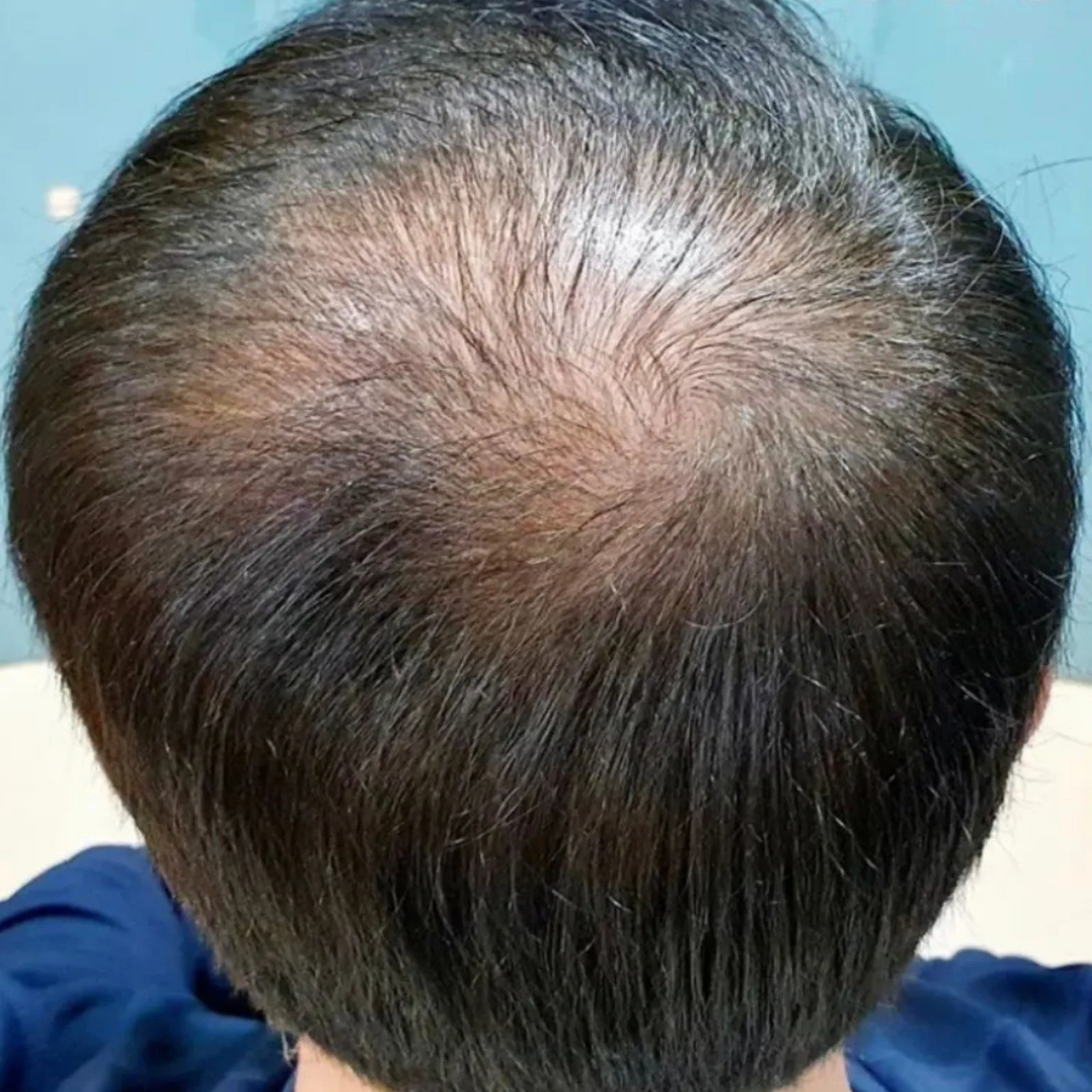 Perma Scalp Before